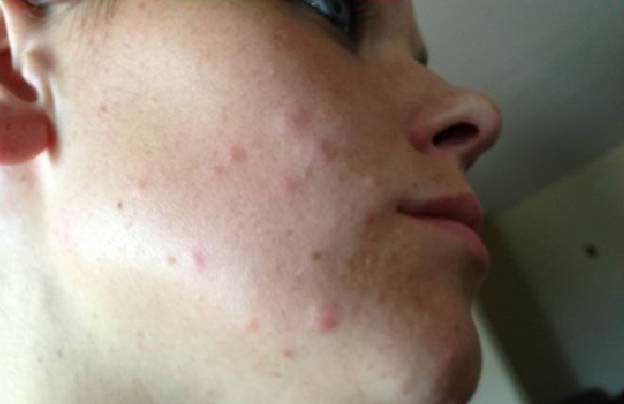 Bed Bug Bites on Face